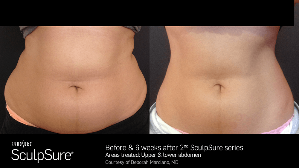 sculpsure uk near me