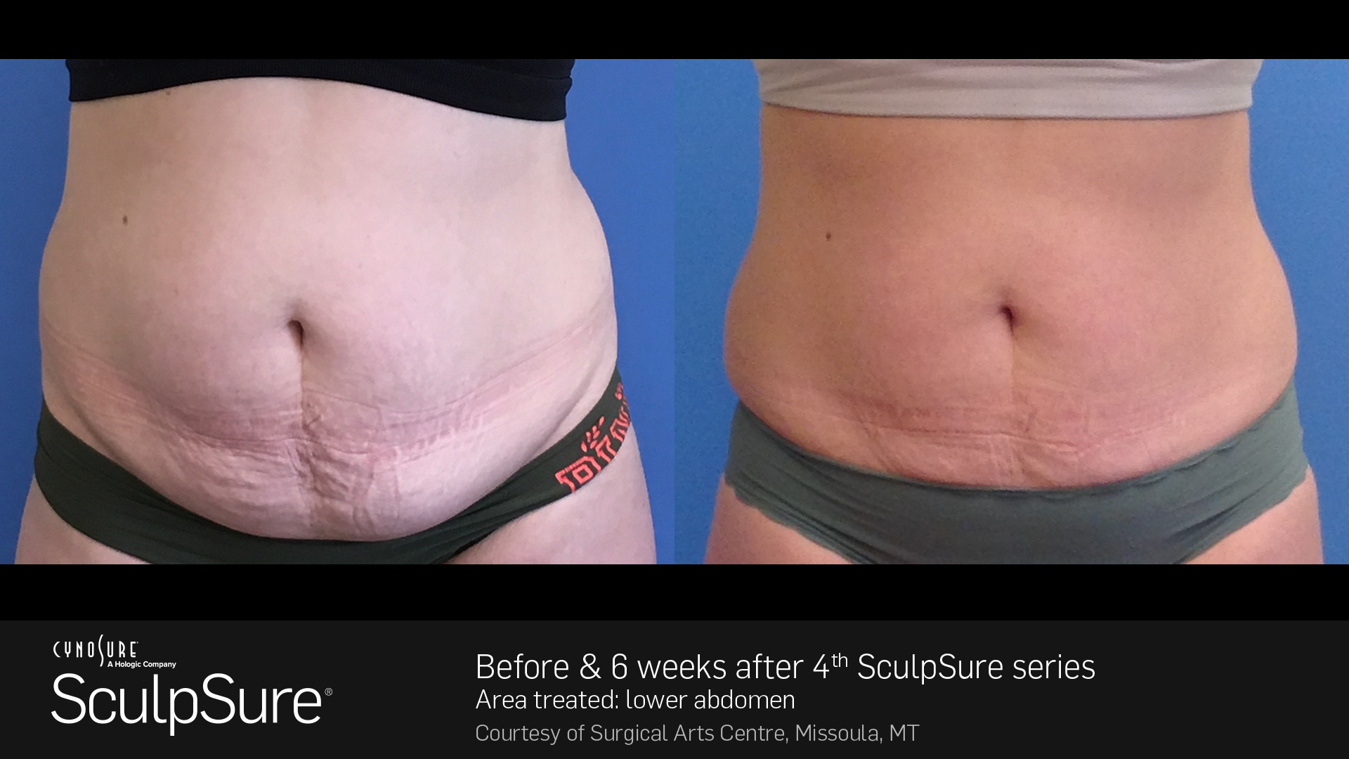 5 Reasons Why Body Sculpting with SculpSure Remains So Popular